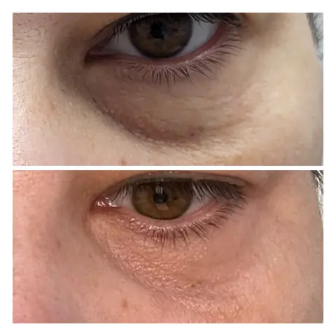 Plasma pen: în stânga înainte, în dreapta după