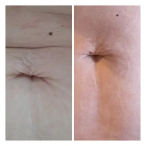 Plasma pen: în stânga înainte, în dreapta după