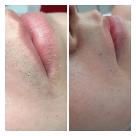 Epilare laser: în stânga înainte, în dreapta după
