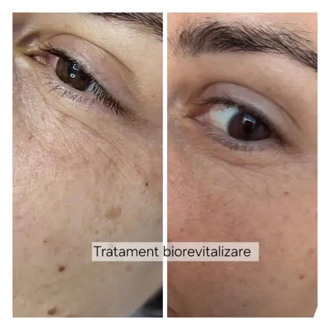 Tratament de biorevitalizare: în stânga înainte, în dreapta după