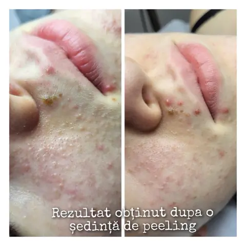 Peeling chimic: în stânga înainte, în dreapta după