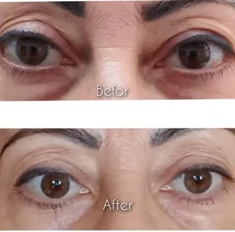 Plasma pen: în stânga înainte, în dreapta după