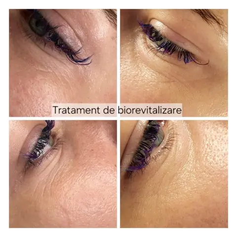 Tratament de biorevitalizare: în stânga înainte, în dreapta după